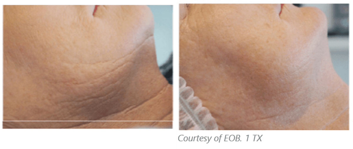 Subnovii Plasma Pen Before & After Gallery - Patient 60803973 - Image 1