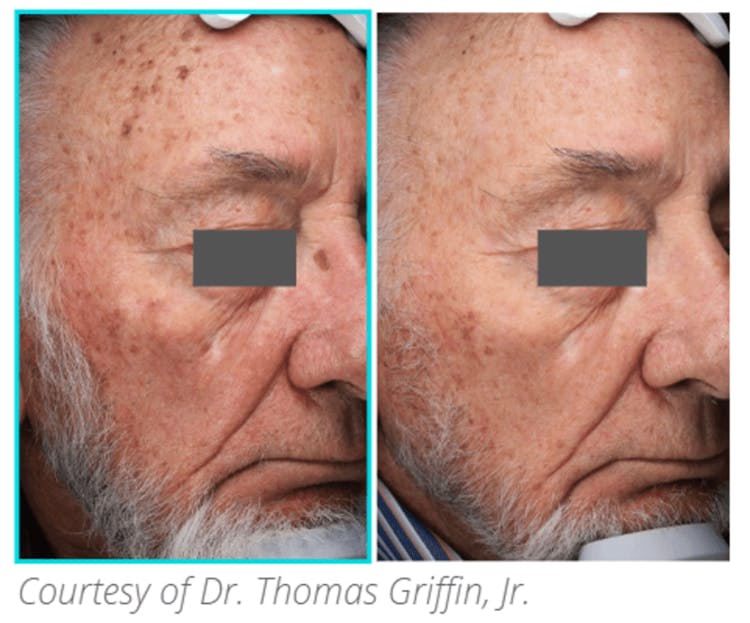 Subnovii Plasma Pen Before & After Gallery - Patient 60803975 - Image 1