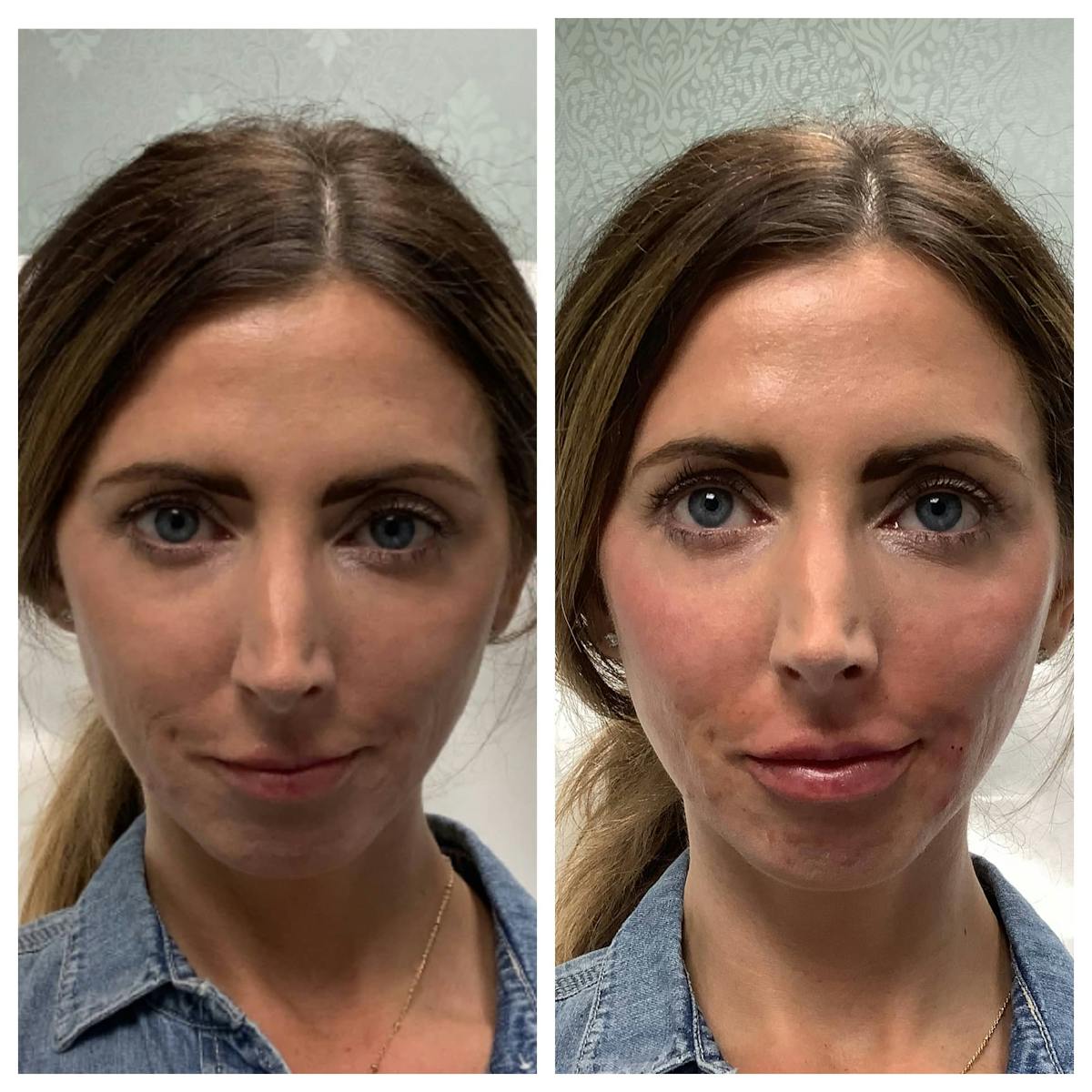 Dermal Filler Before & After Gallery - Patient 122227047 - Image 1