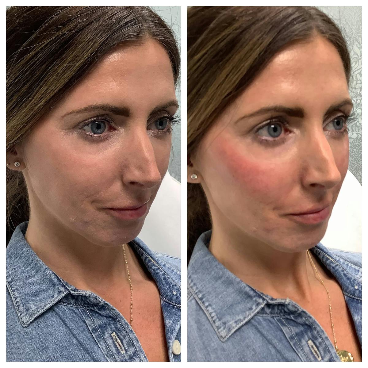 Dermal Filler Before & After Gallery - Patient 122227047 - Image 2