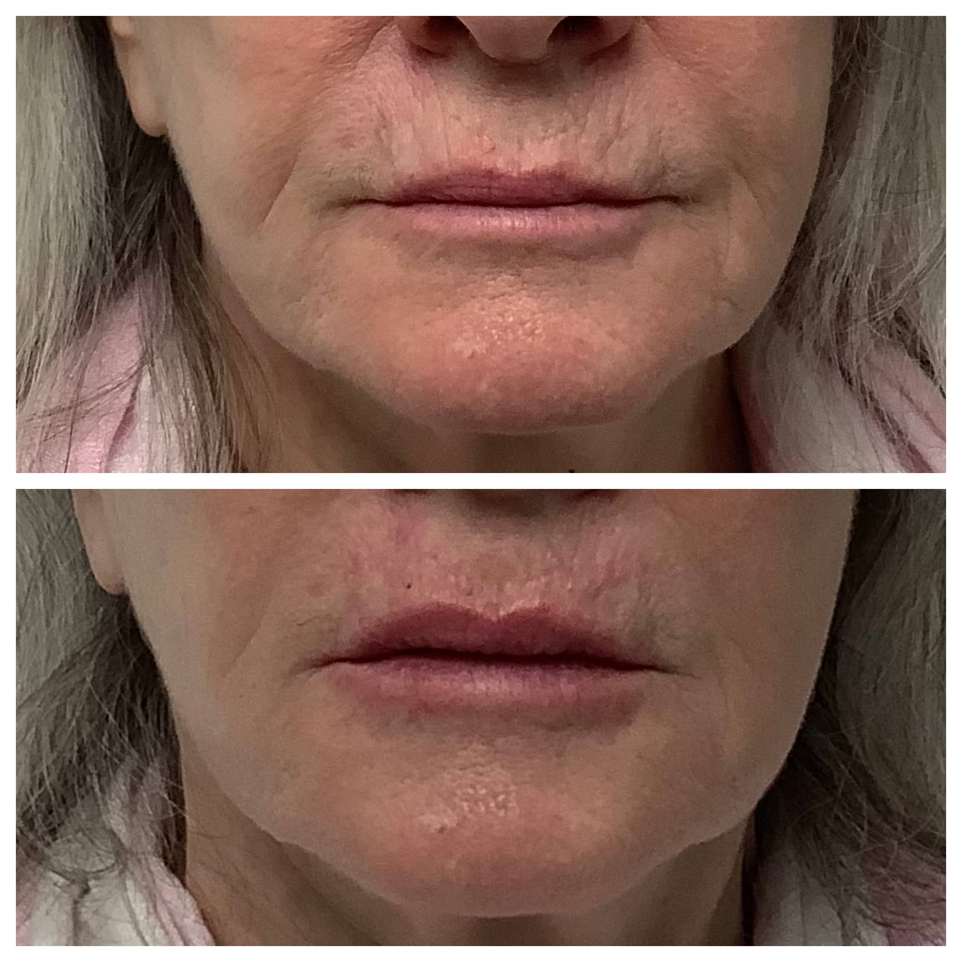 Dermal Filler Before & After Photos Face Forward Medical Aesthetics