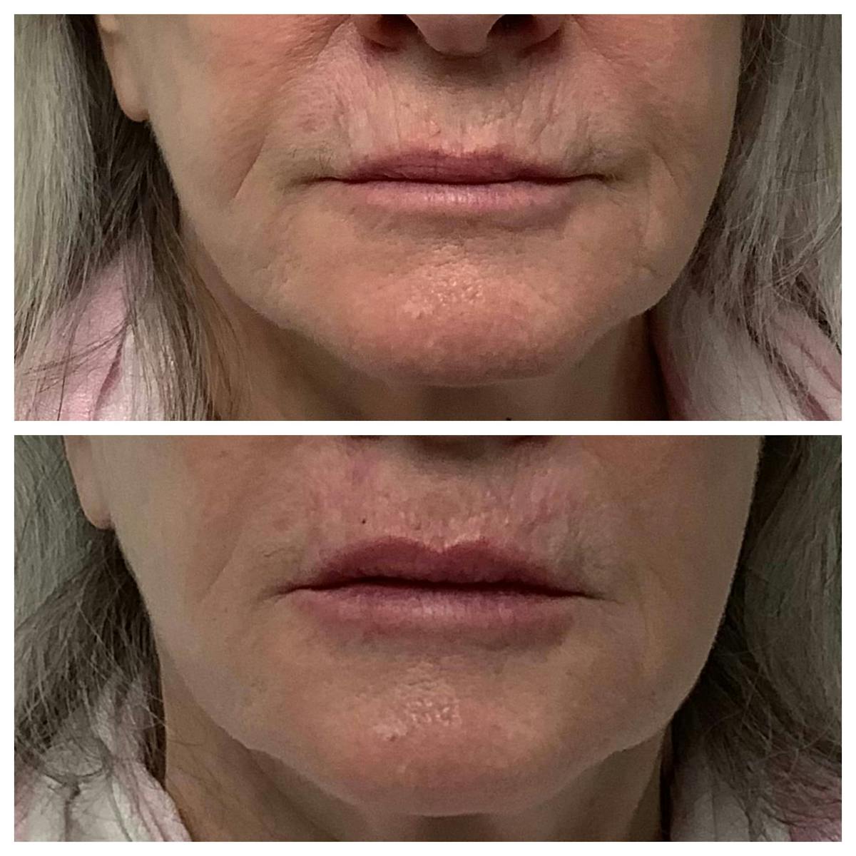 Dermal Filler Before & After Gallery - Patient 122227048 - Image 2