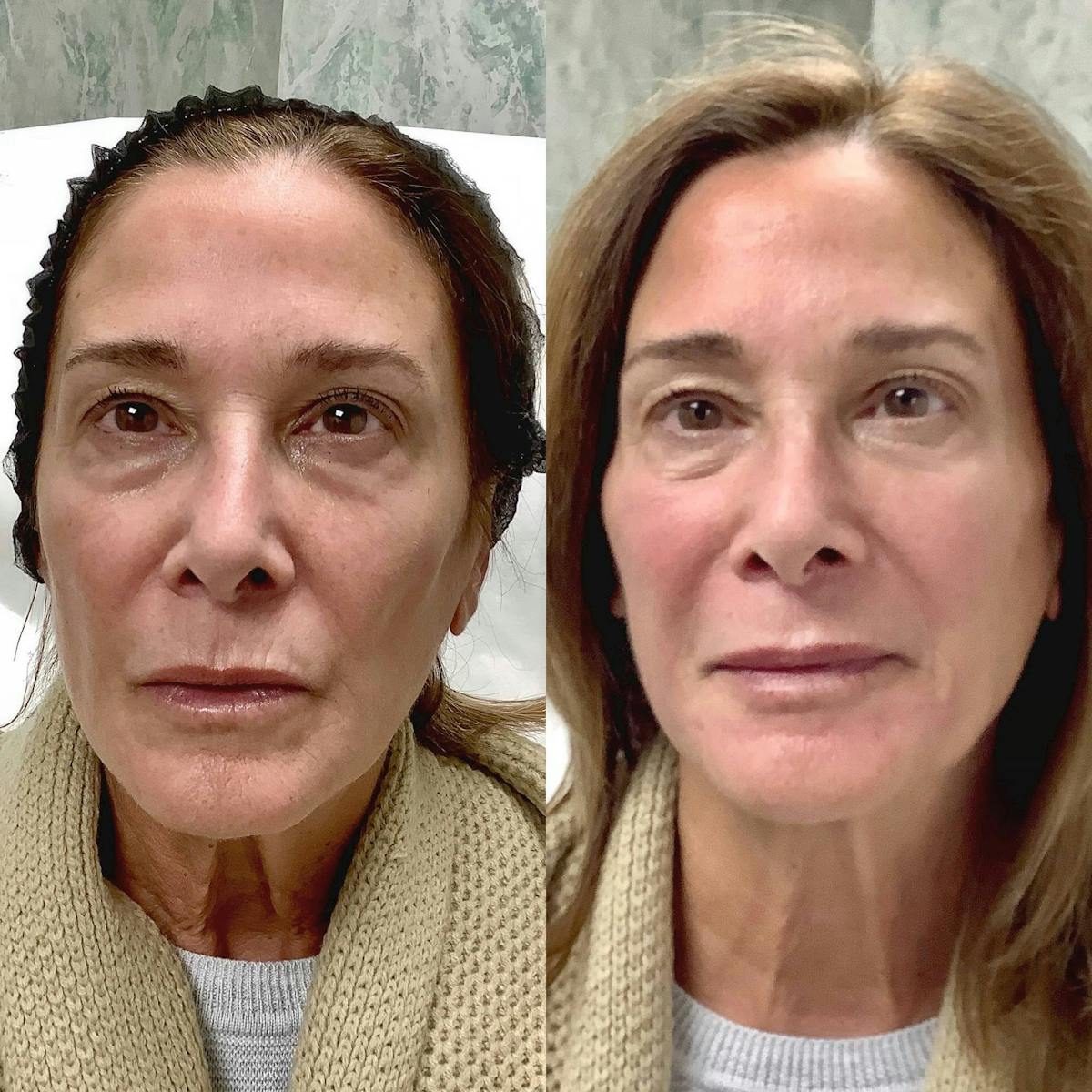 Dermal Filler Before & After Gallery - Patient 122227049 - Image 1