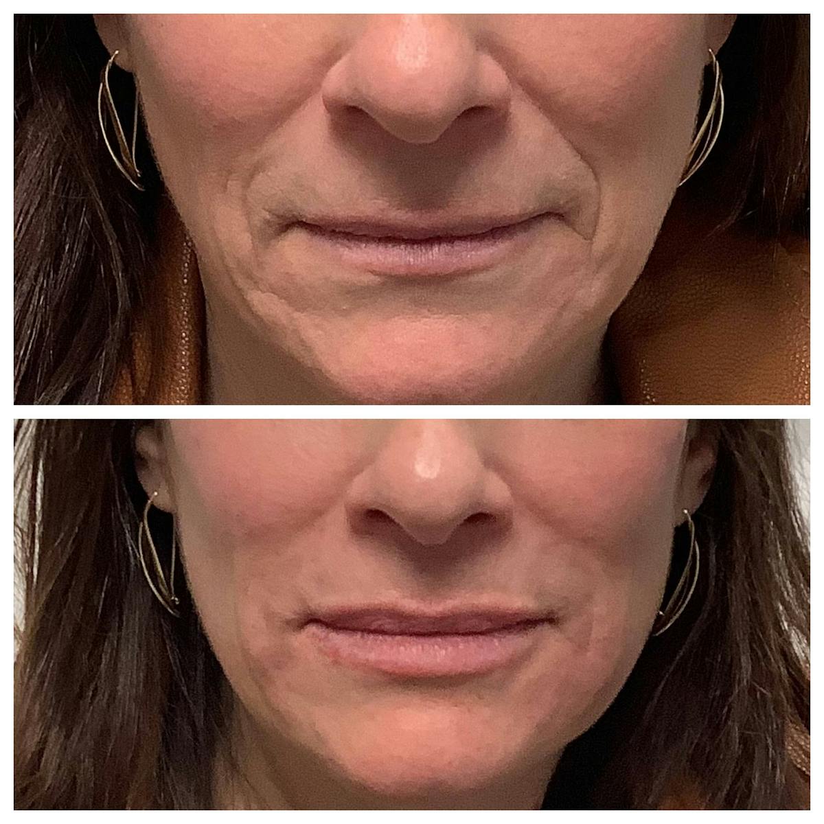 Dermal Filler Before & After Gallery - Patient 122227050 - Image 1