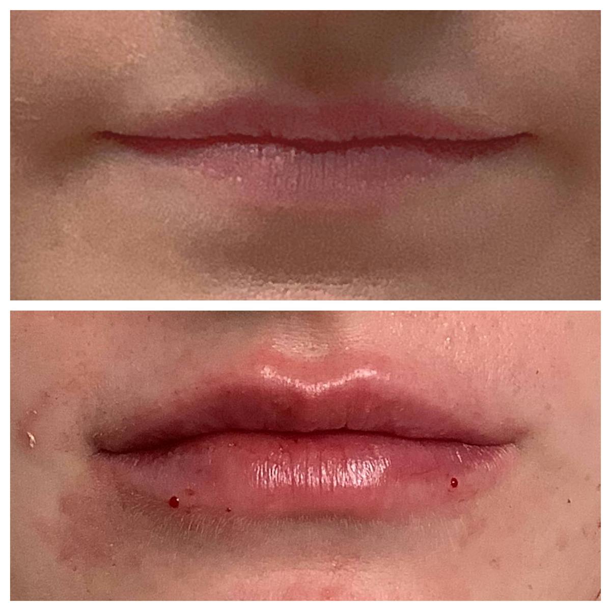 Dermal Filler Before & After Gallery - Patient 122227051 - Image 1