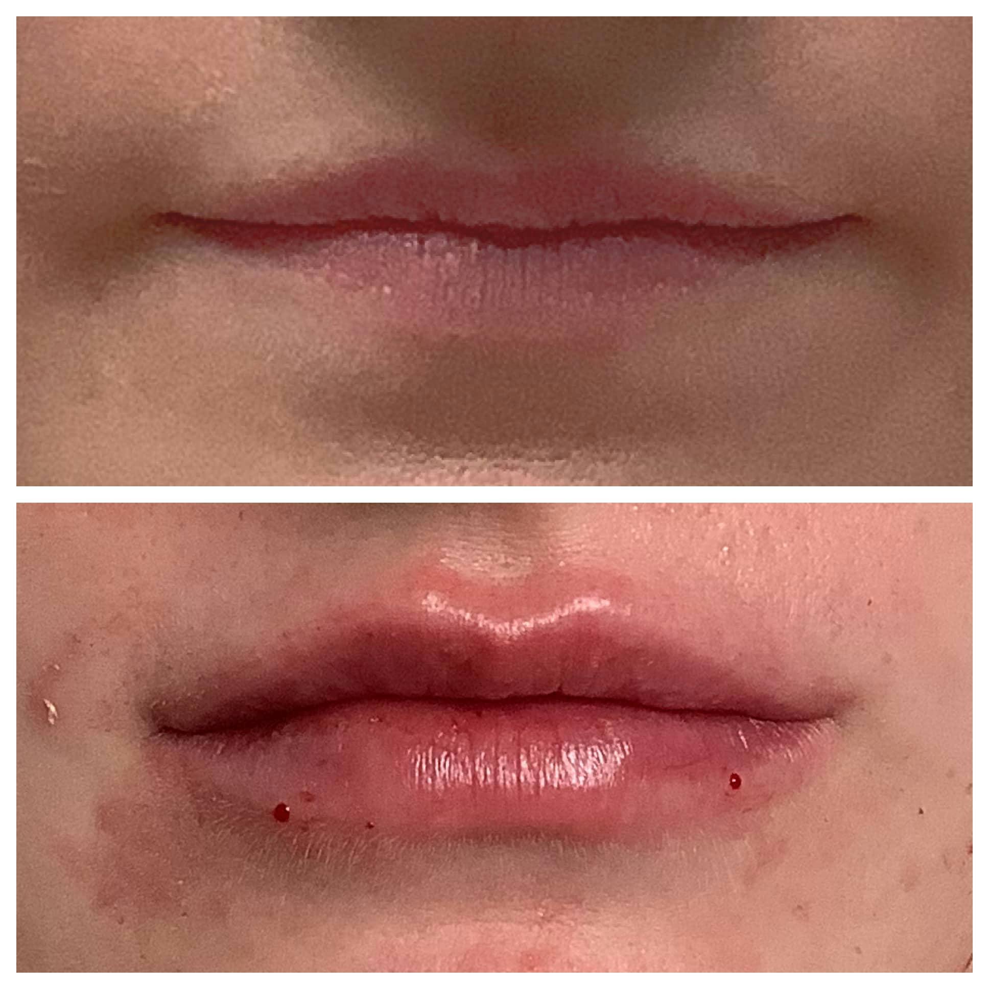 Dermal Filler Before & After Gallery - Patient 122227051 - Image 1
