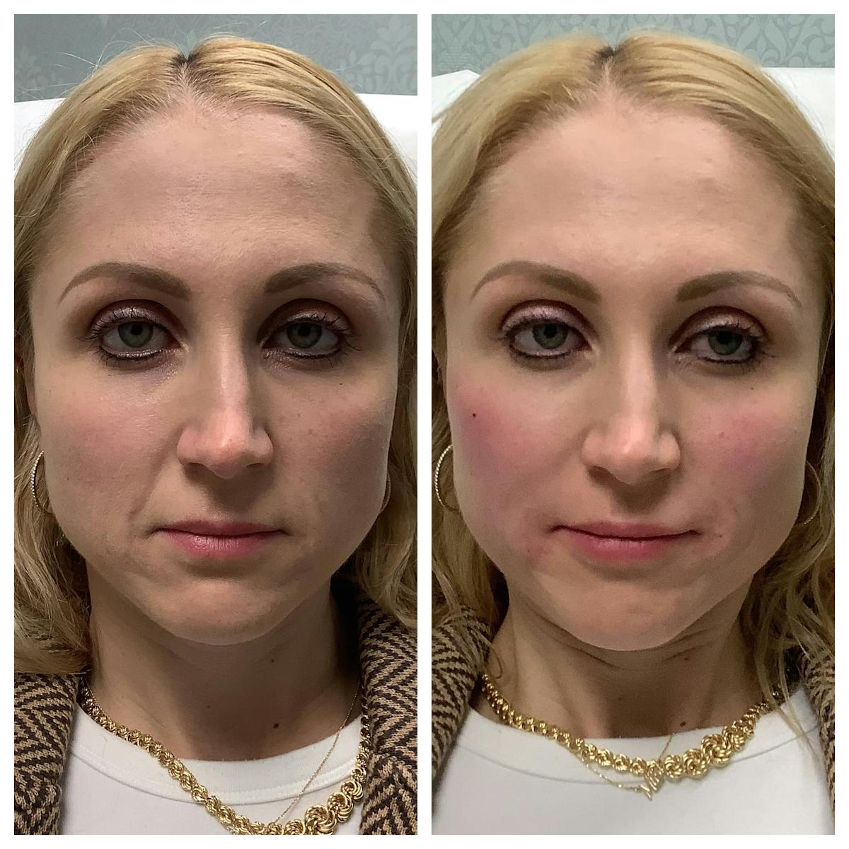 Dermal Filler Before & After Gallery - Patient 122227052 - Image 1