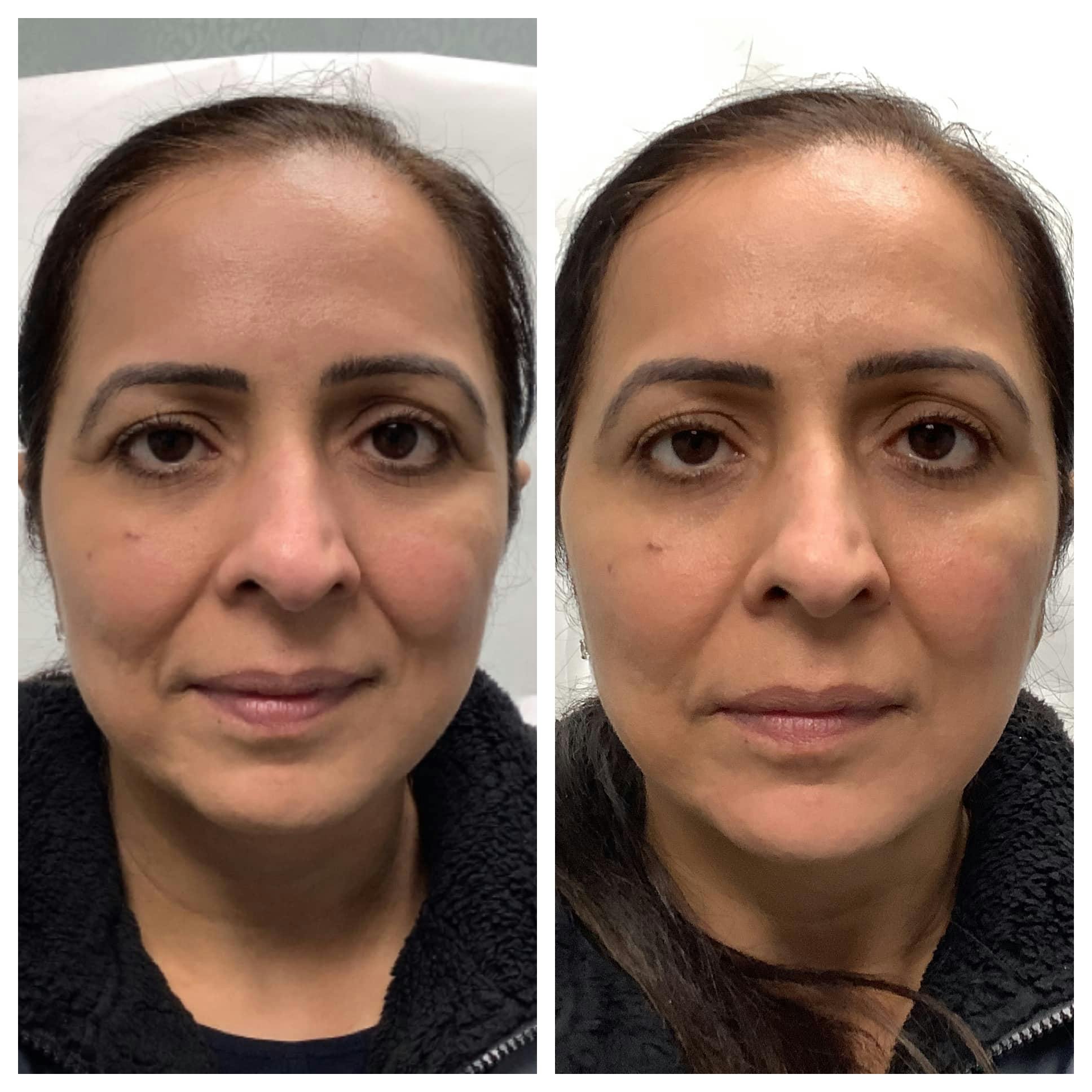 Dermal Filler Before & After Gallery - Patient 122227053 - Image 1
