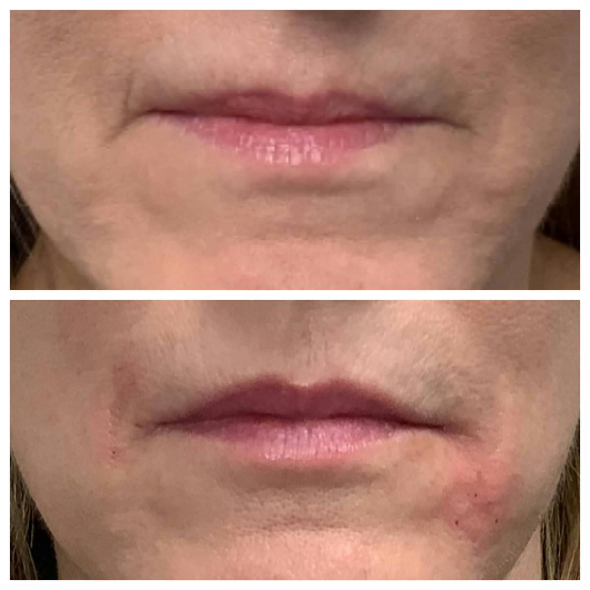 Dermal Filler Before & After Gallery - Patient 122227054 - Image 1