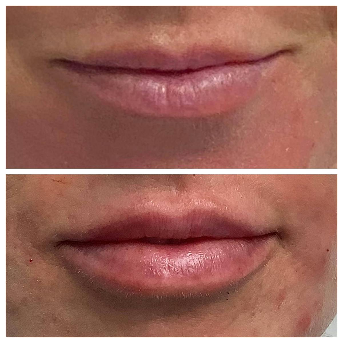 Dermal Filler Before & After Gallery - Patient 122227055 - Image 1