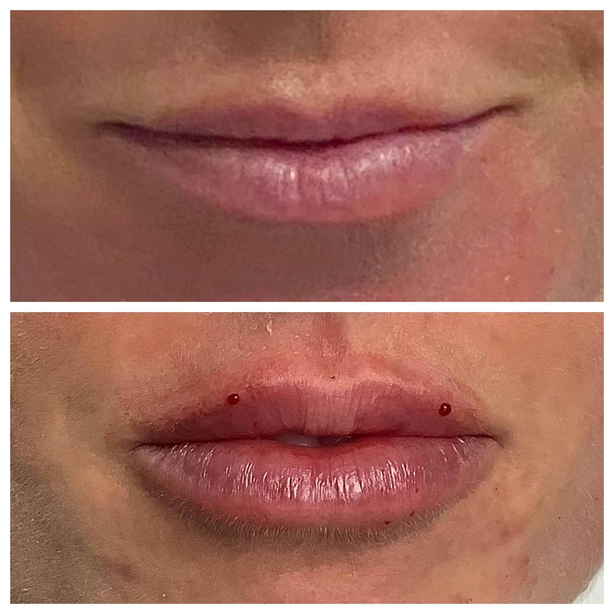 Dermal Filler Before & After Gallery - Patient 122227056 - Image 1