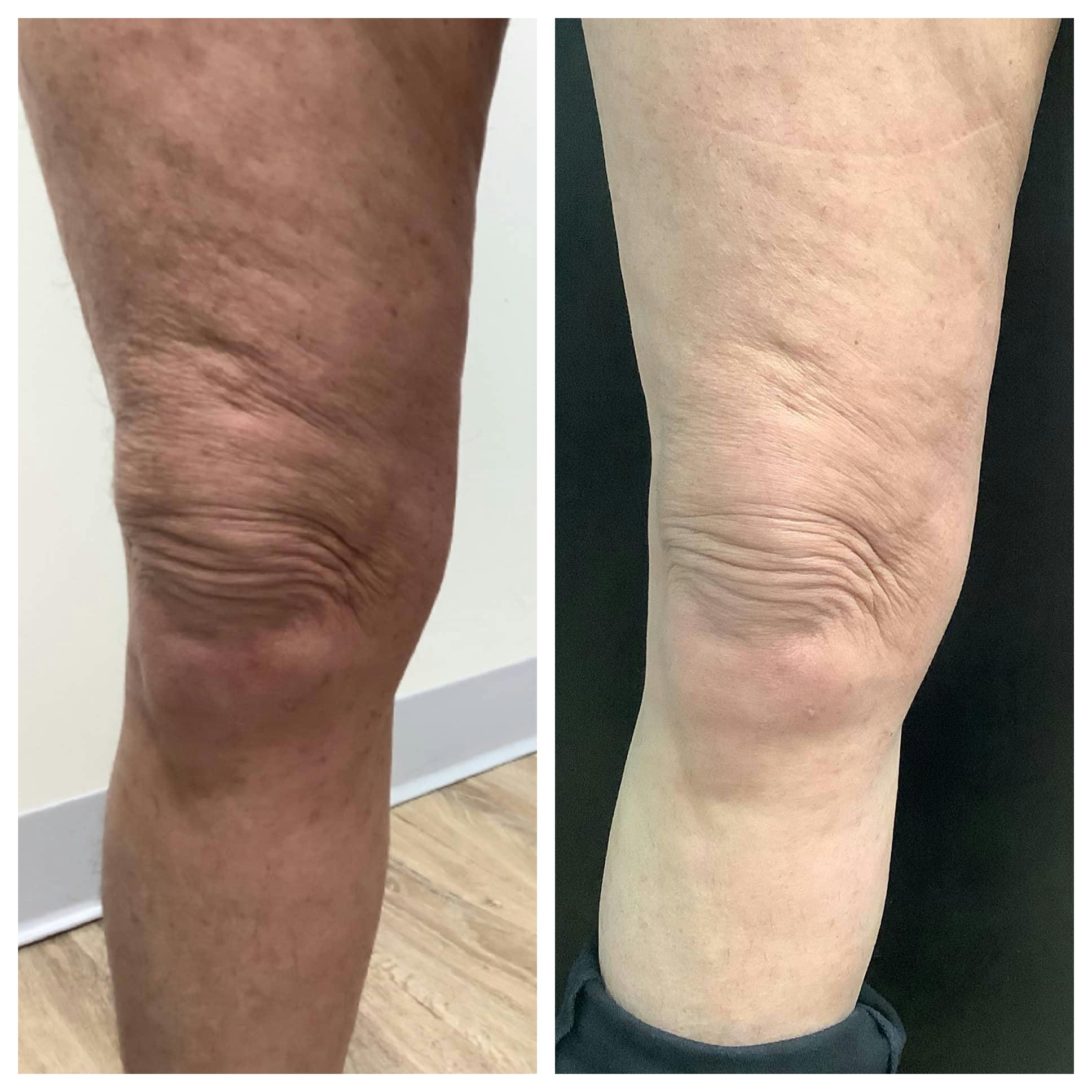 Microneedling in Lexington, MA, Before & After Photos