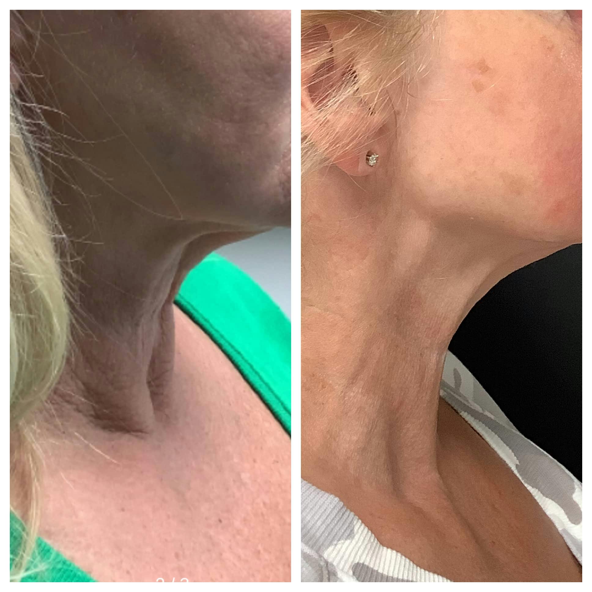 RF Microneedling Before & After Gallery - Patient 122227081 - Image 2