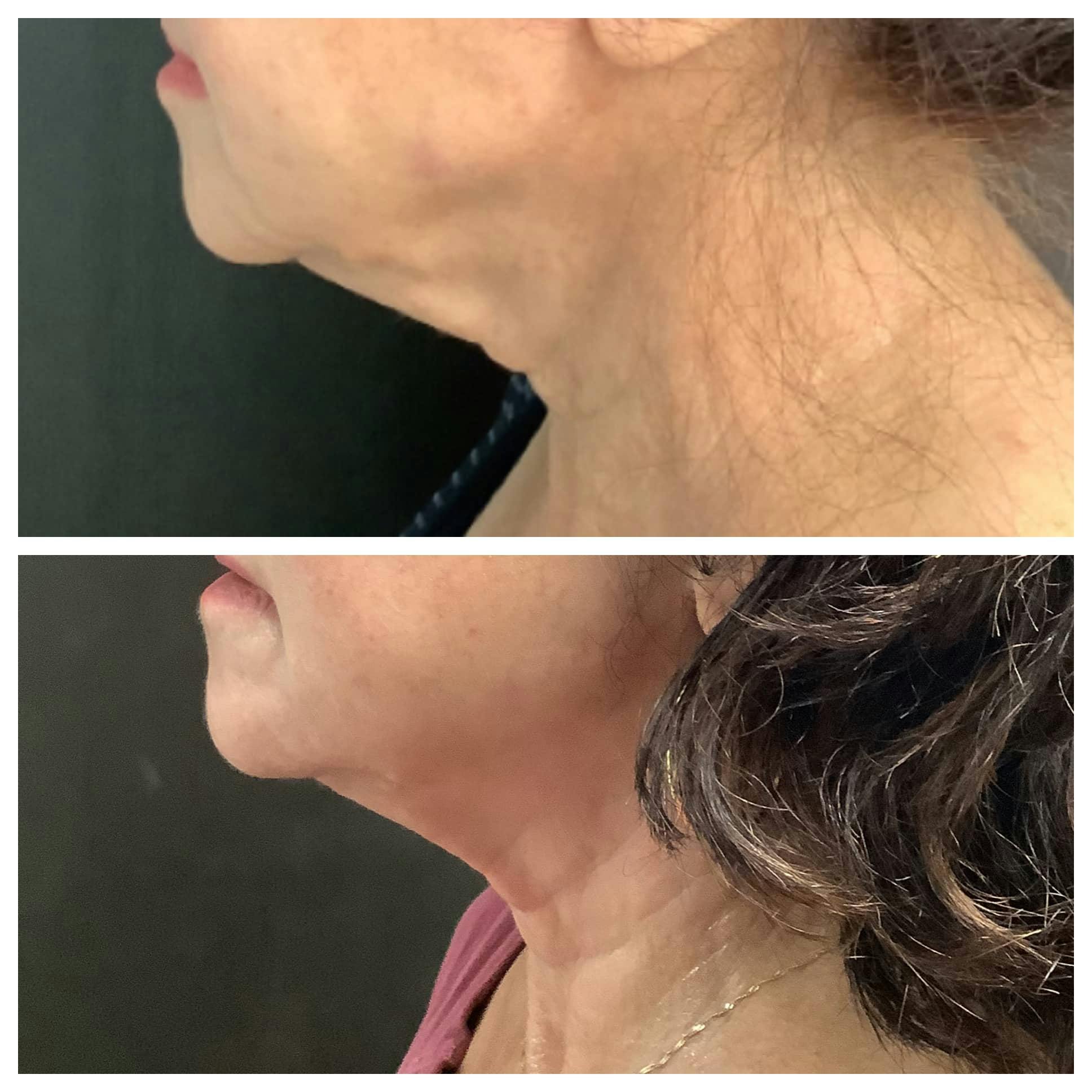 RF Microneedling Before & After Gallery - Patient 122227082 - Image 1