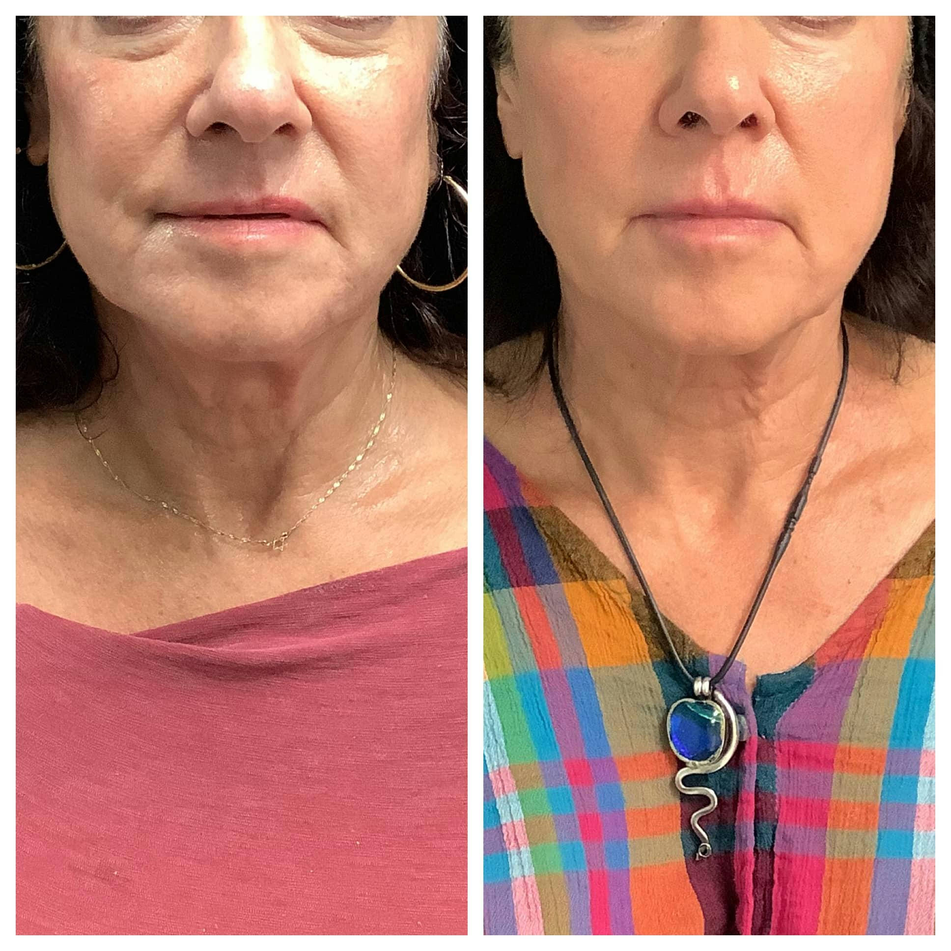 RF Microneedling Before & After Gallery - Patient 122227082 - Image 2