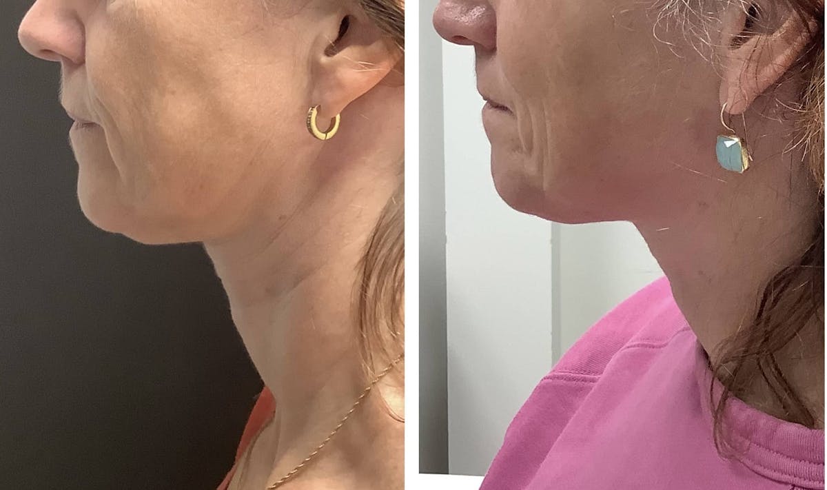 RF Microneedling Before & After Gallery - Patient 122227083 - Image 1