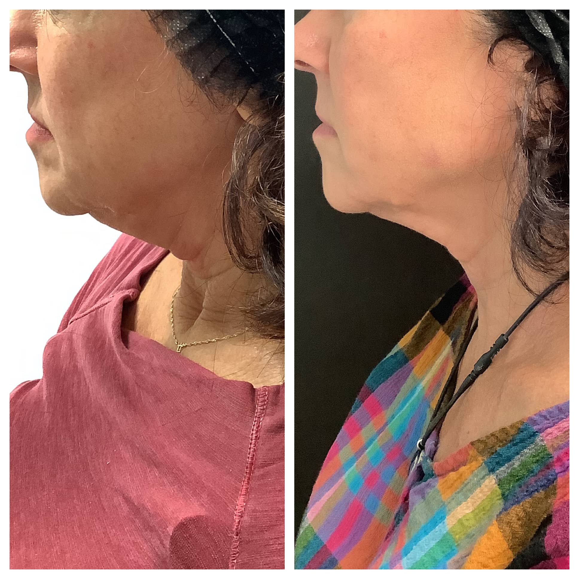 RF Microneedling Before & After Photos Face Forward Medical Aesthetics