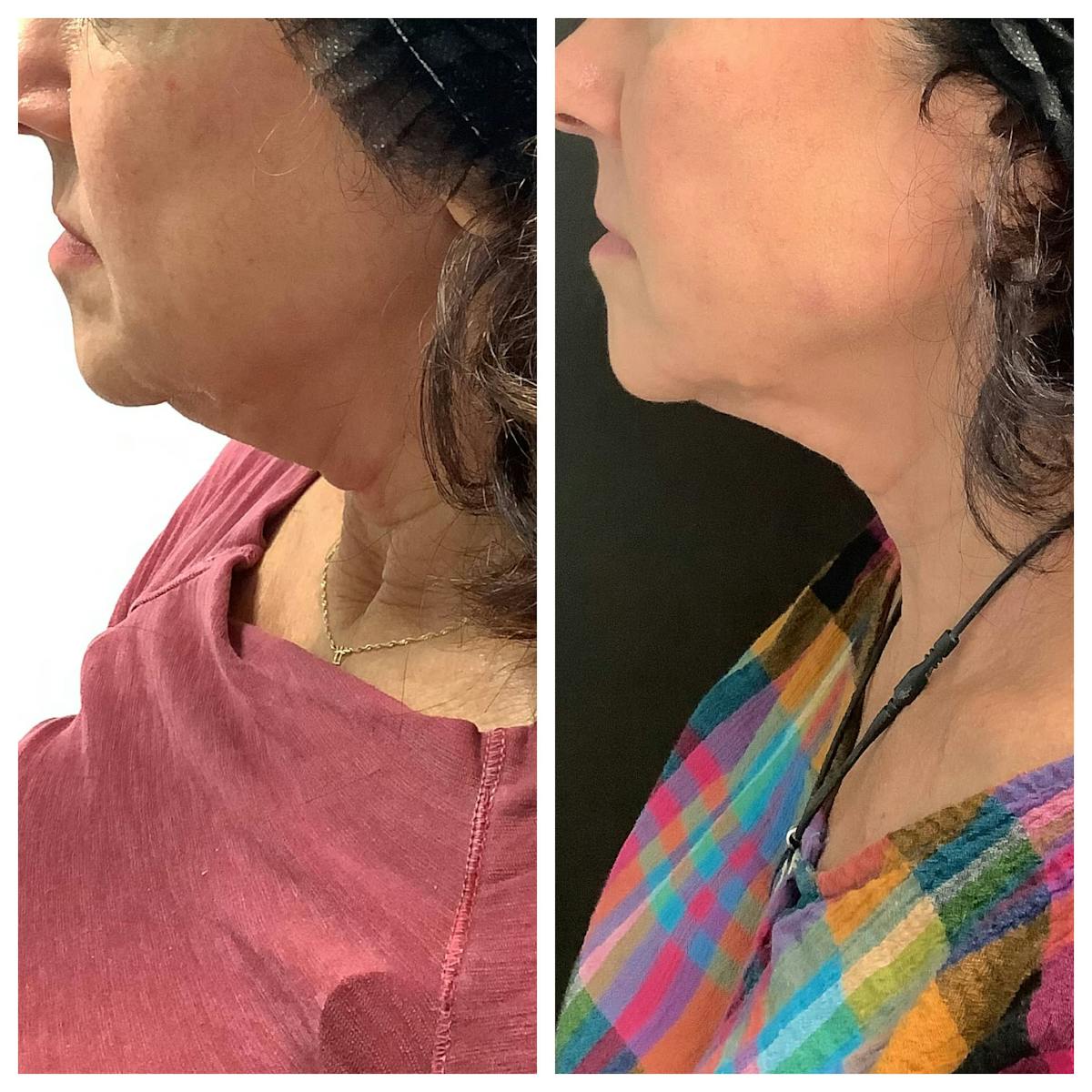 RF Microneedling Before & After Gallery - Patient 122227082 - Image 3