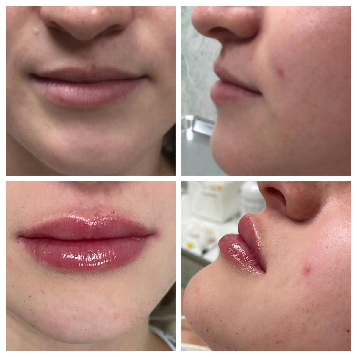 Dermal Filler Before & After Gallery - Patient 154061 - Image 1