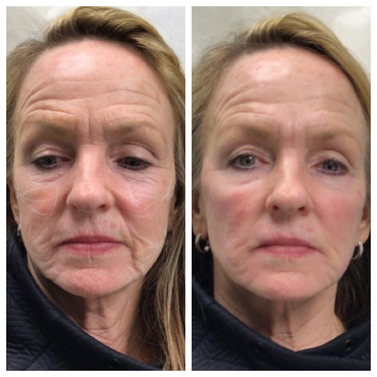 Dermal Filler Before & After Gallery - Patient 143255 - Image 1