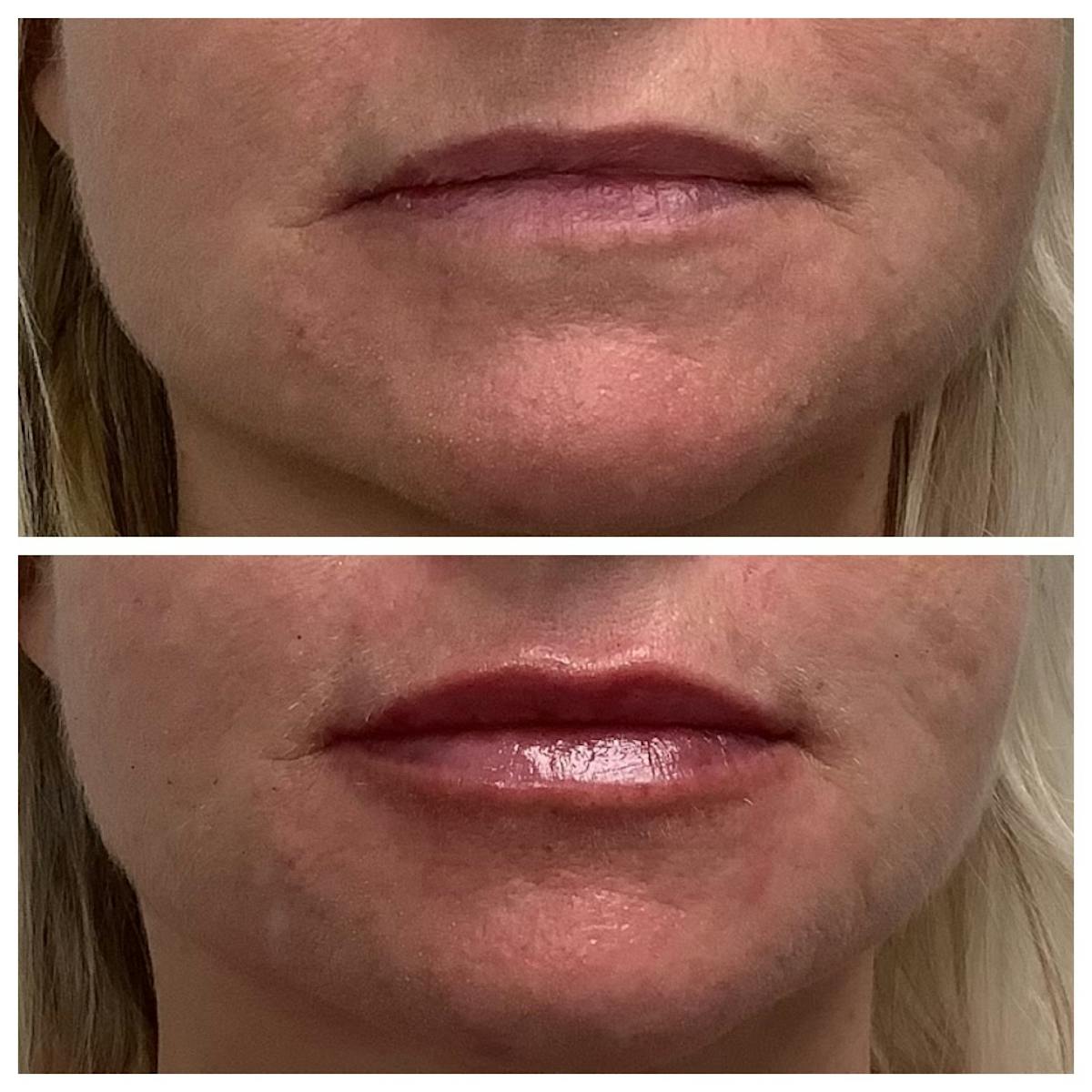 Dermal Filler Before & After Gallery - Patient 398732 - Image 1