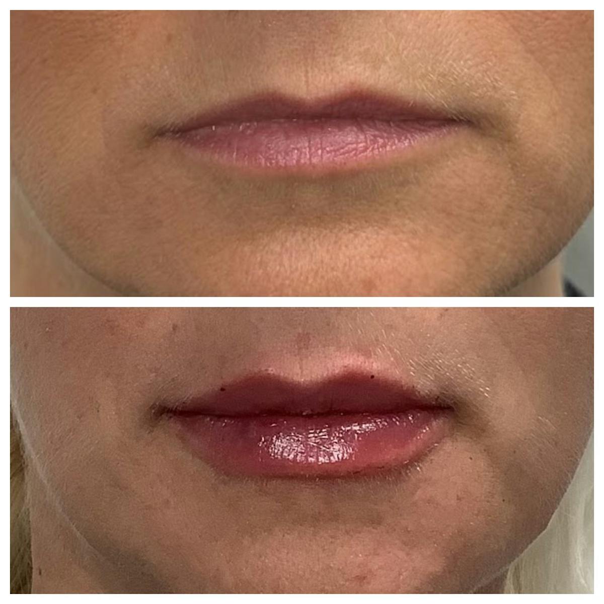 Dermal Filler Before & After Gallery - Patient 229275 - Image 1