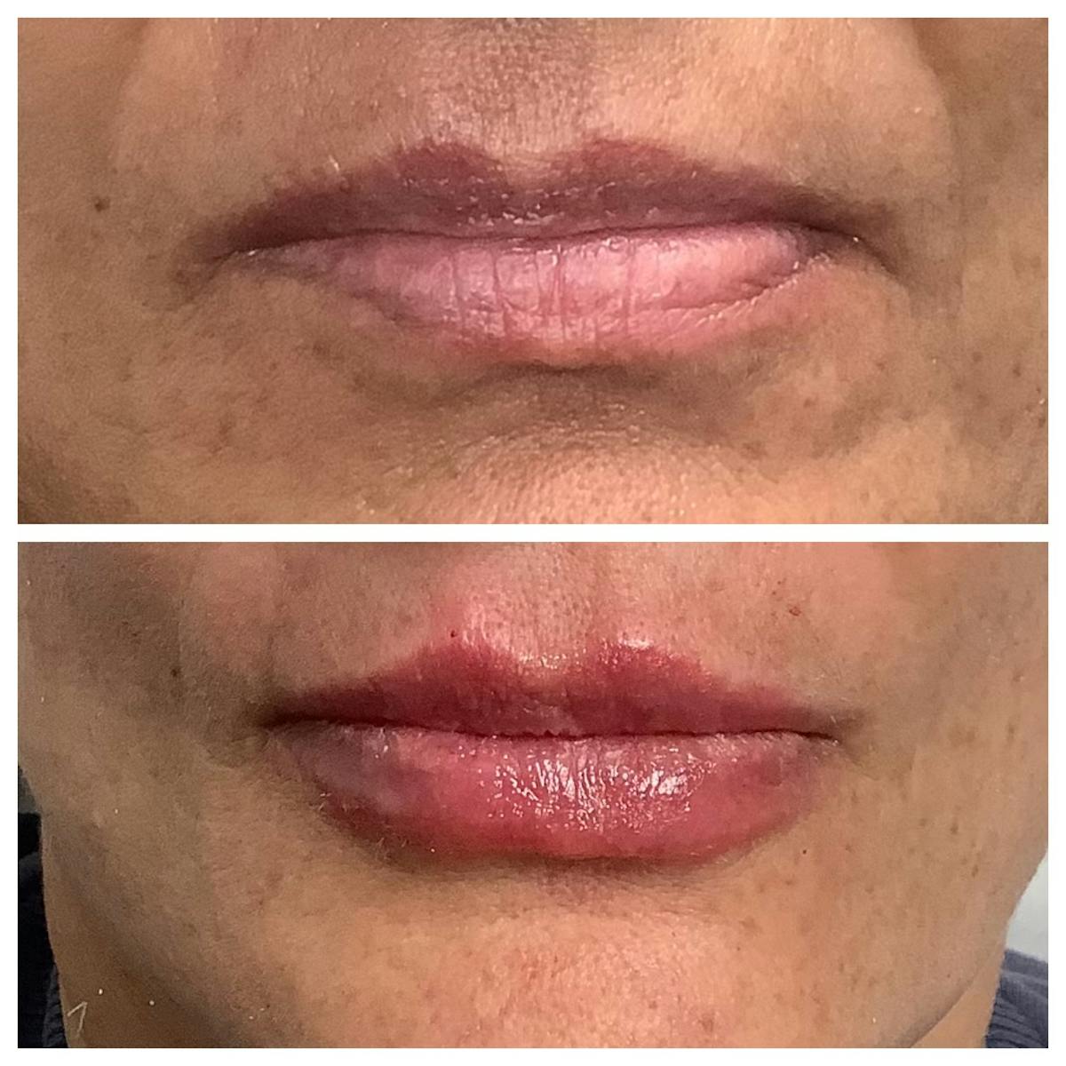 Dermal Filler Before & After Gallery - Patient 850132 - Image 1