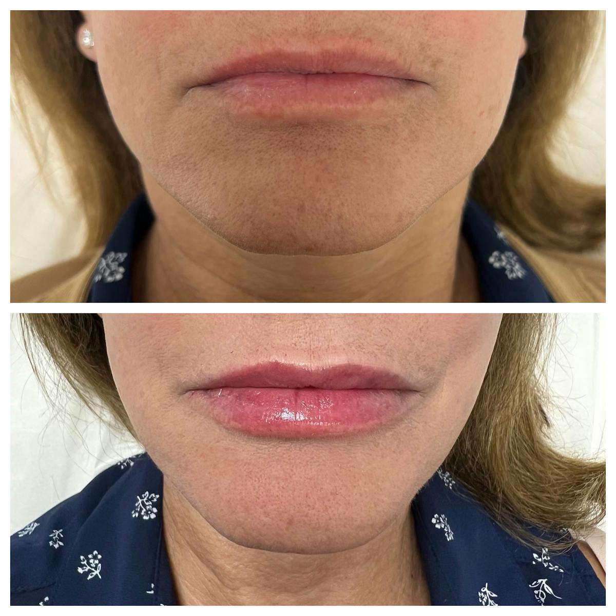 Dermal Filler Before & After Gallery - Patient 521279 - Image 1