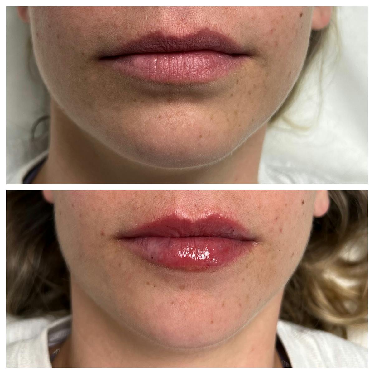 Dermal Filler Before & After Gallery - Patient 171154 - Image 1