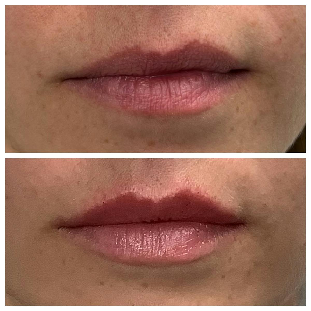 Dermal Filler Before & After Gallery - Patient 186035 - Image 1