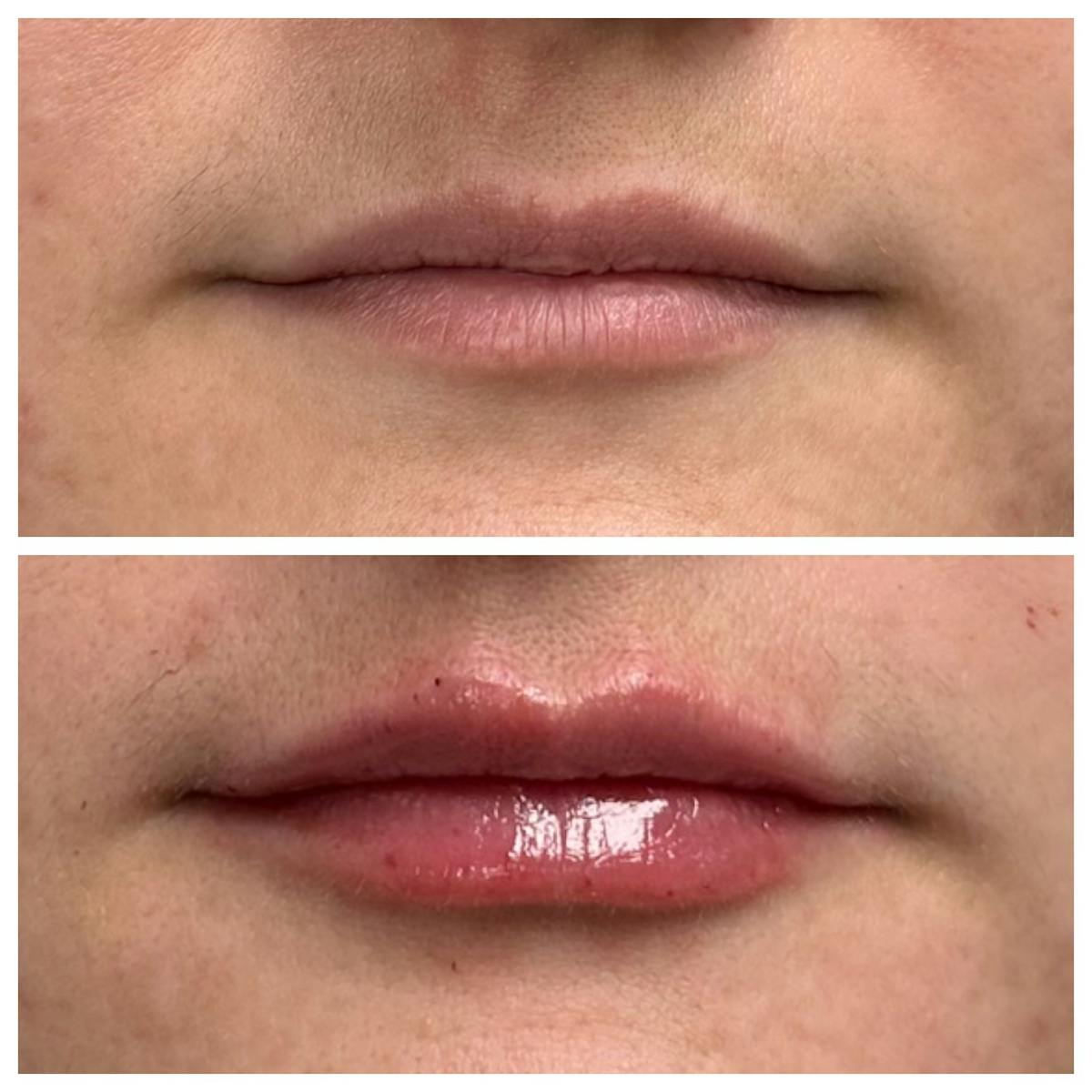 Dermal Filler Before & After Gallery - Patient 351451 - Image 1