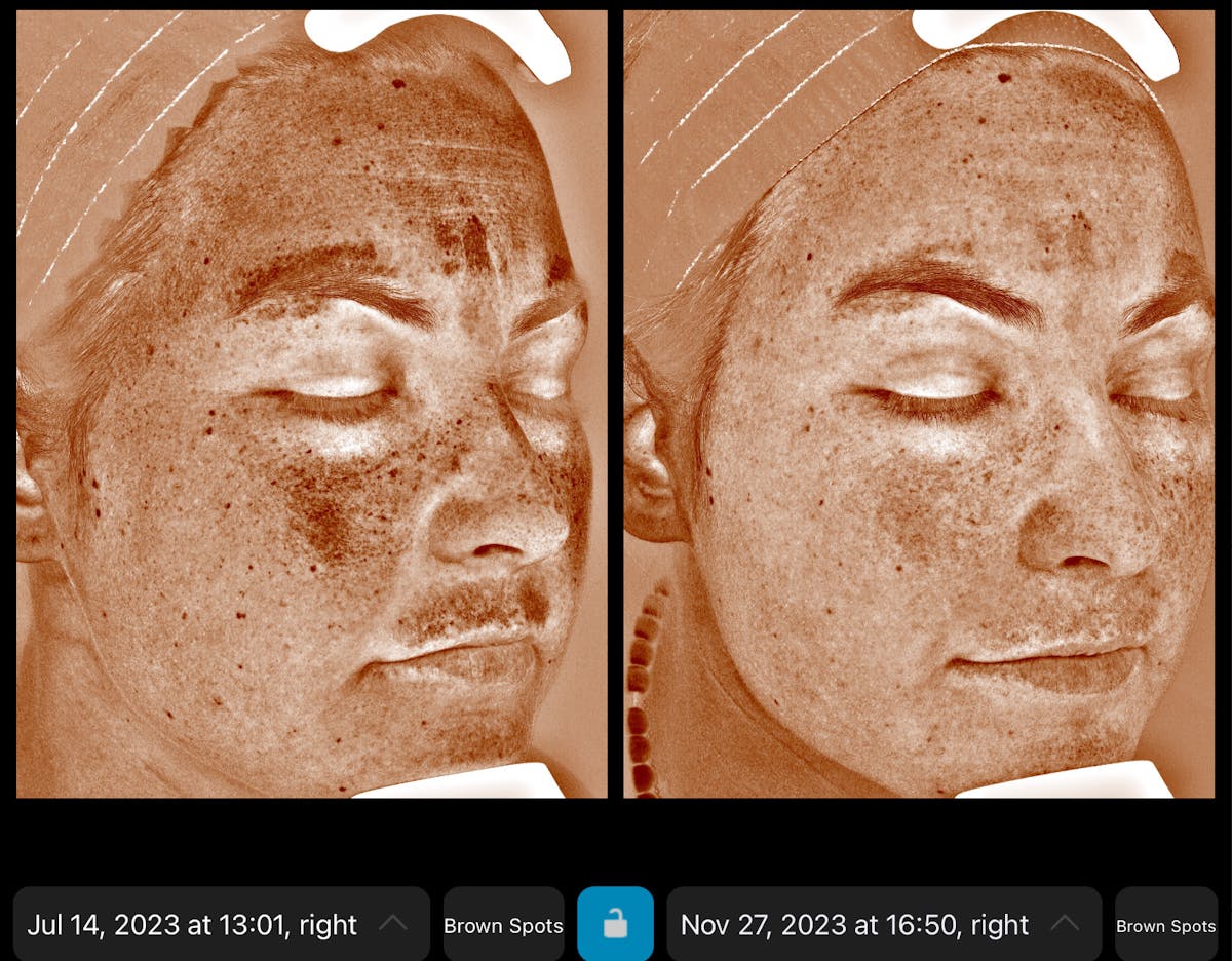 Skincare Before & After Gallery - Patient 218194 - Image 4