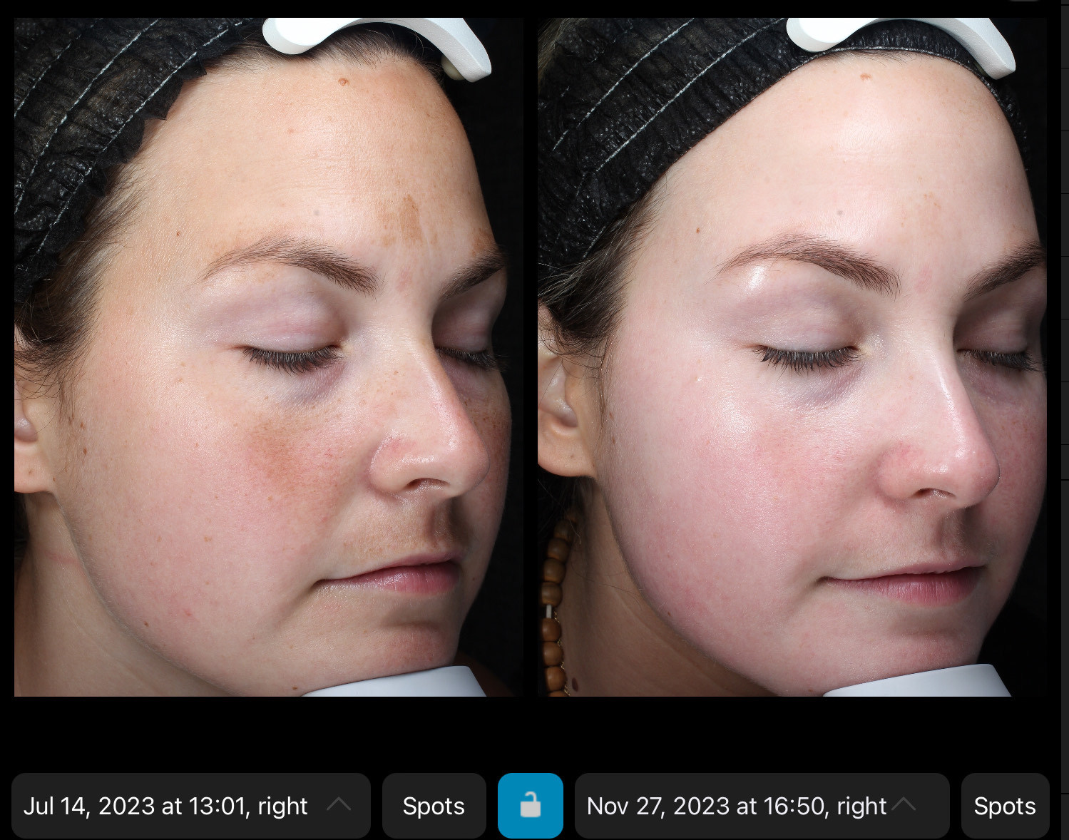 Skincare Before & After Photos Face Forward Medical Aesthetics