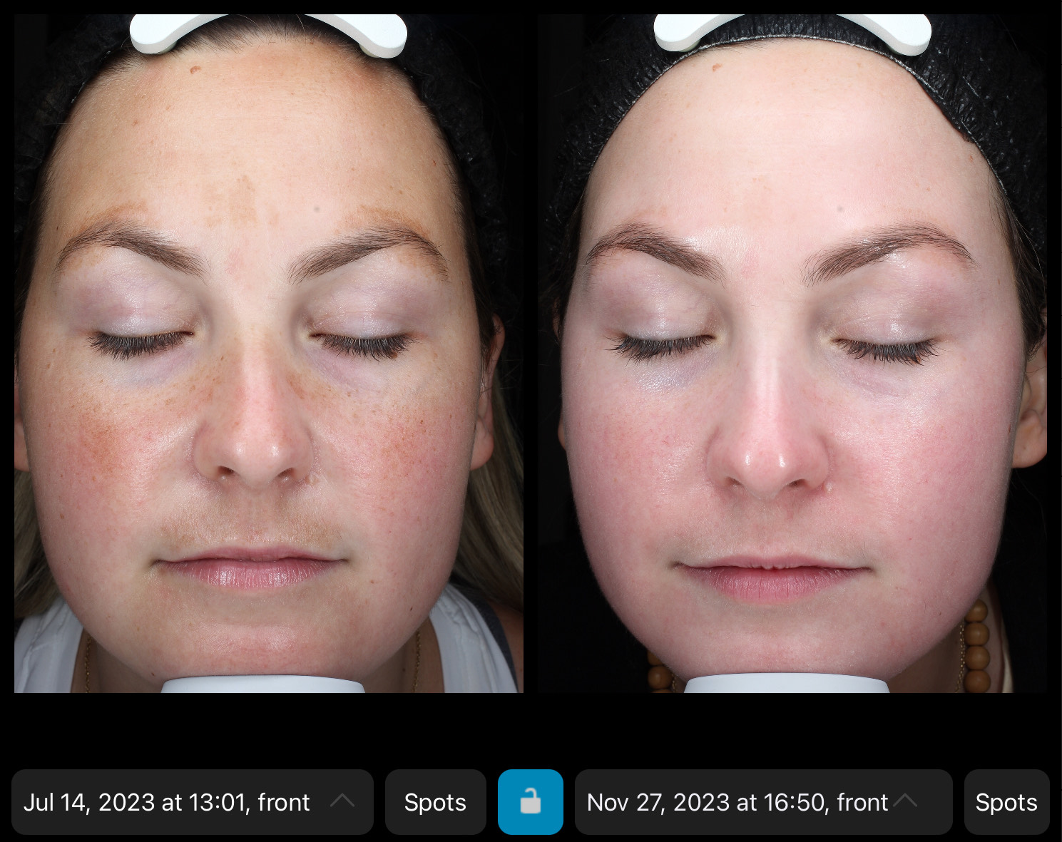 Skincare Before & After Photos Face Forward Medical Aesthetics