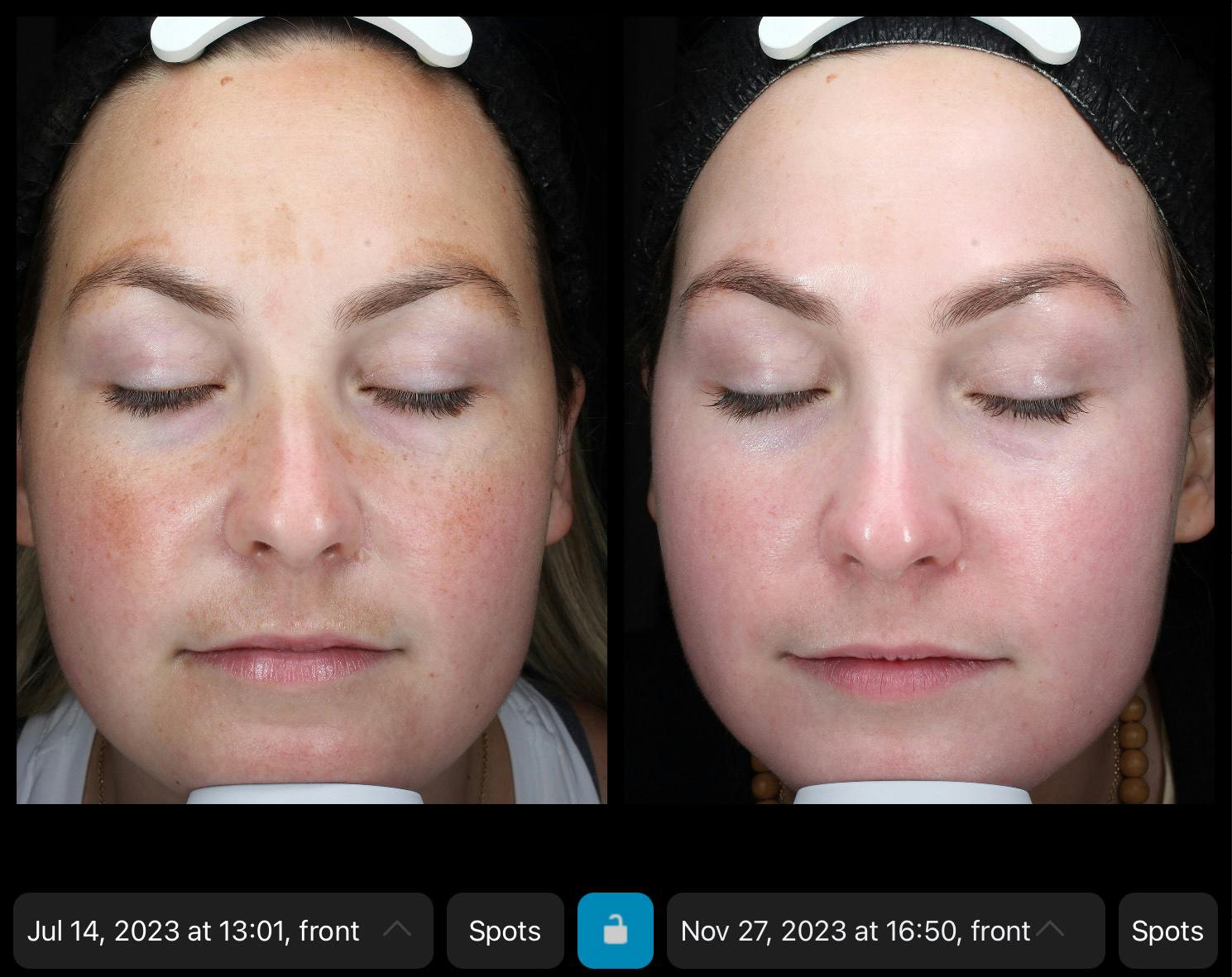 Skincare Before & After Gallery - Patient 218194 - Image 1