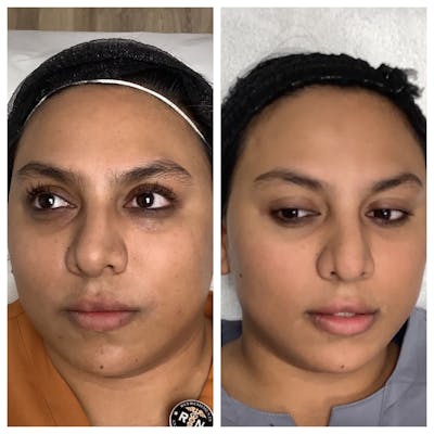 Chemical Peel Before & After Gallery - Patient 303622 - Image 1