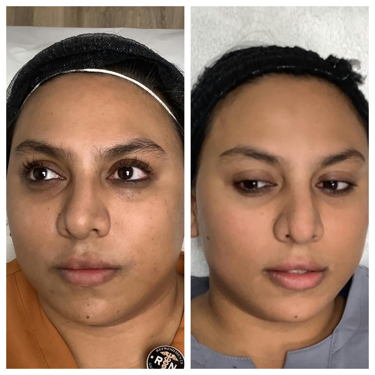 Chemical Peel Before & After Gallery - Patient 303622 - Image 1