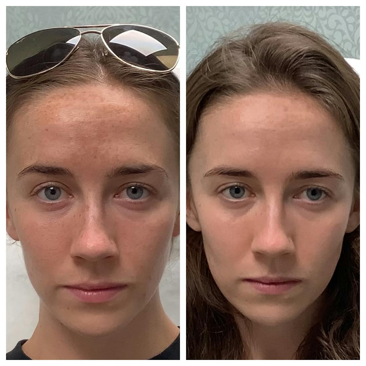 Chemical Peel Before & After Gallery - Patient 491939 - Image 1