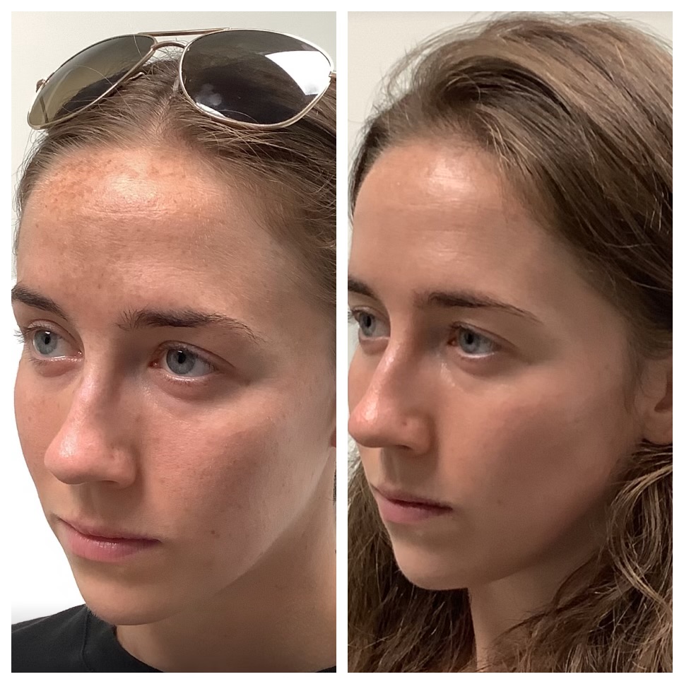 Chemical Peel Before & After Photos Face Forward Medical Aesthetics