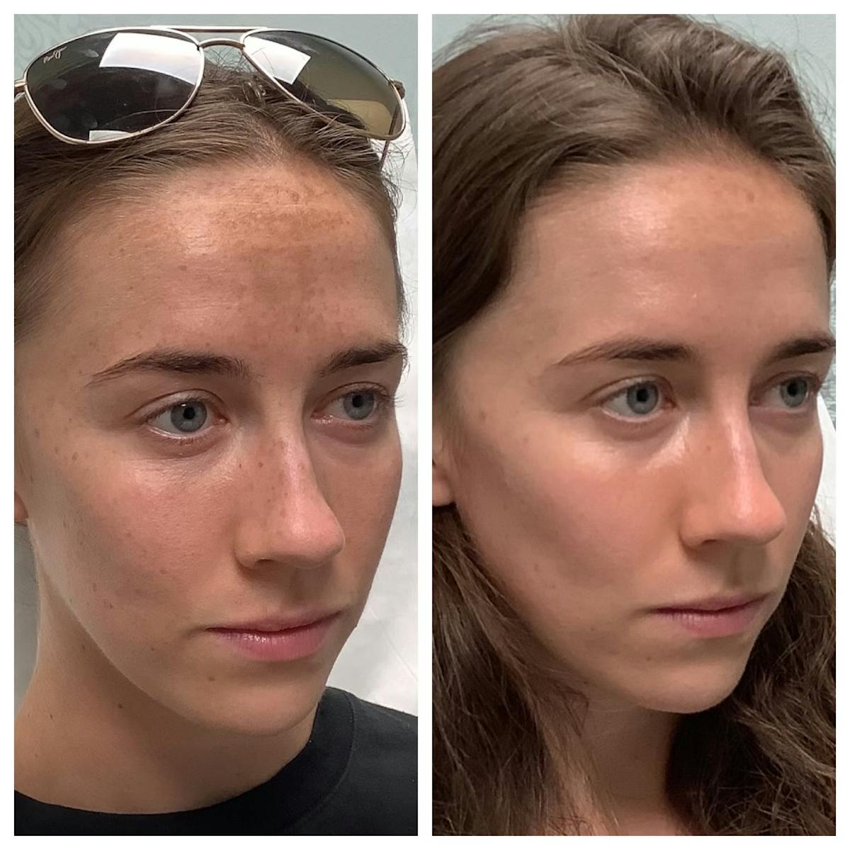 Chemical Peel Before & After Gallery - Patient 491939 - Image 3
