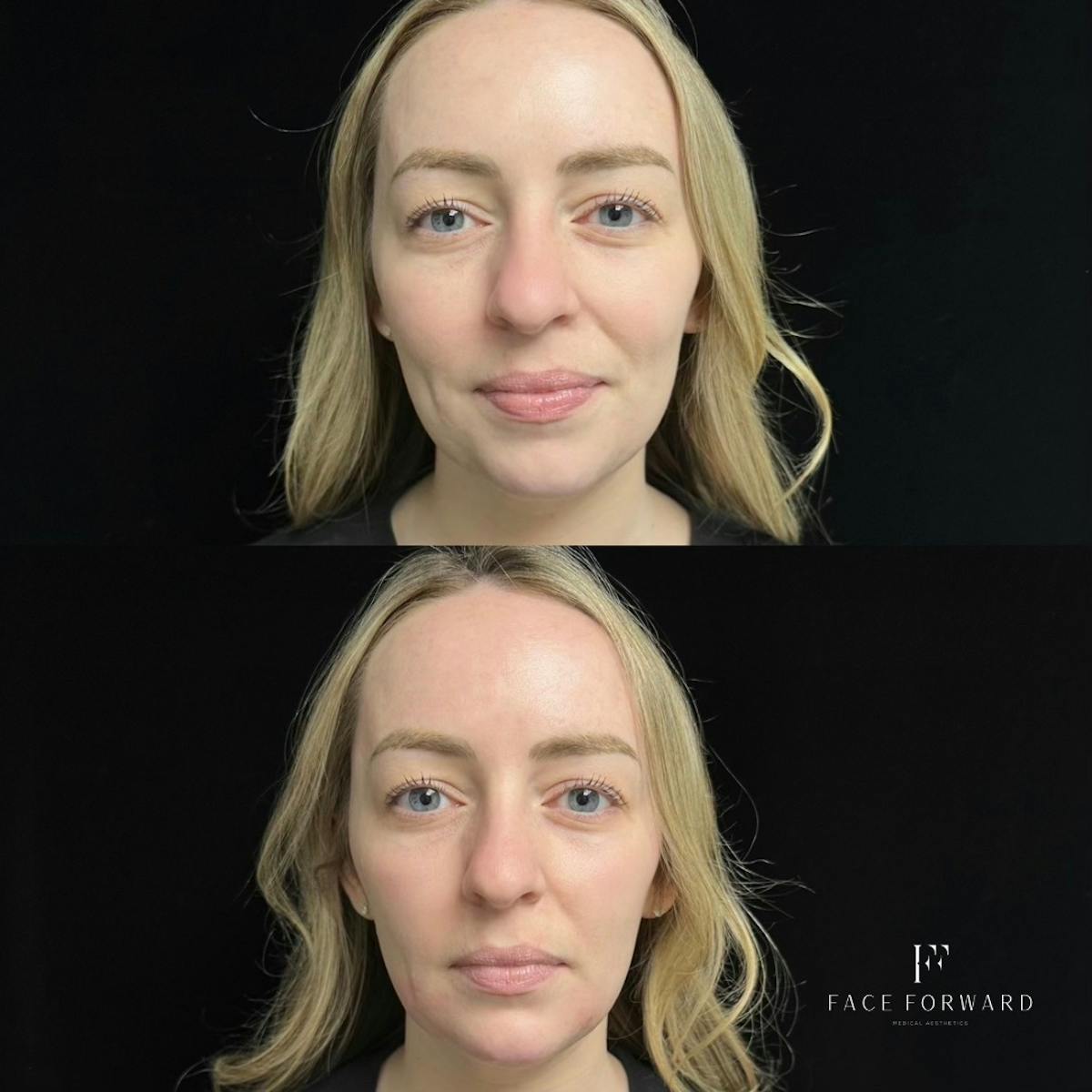 Dermal Filler Before & After Gallery - Patient 104346 - Image 1