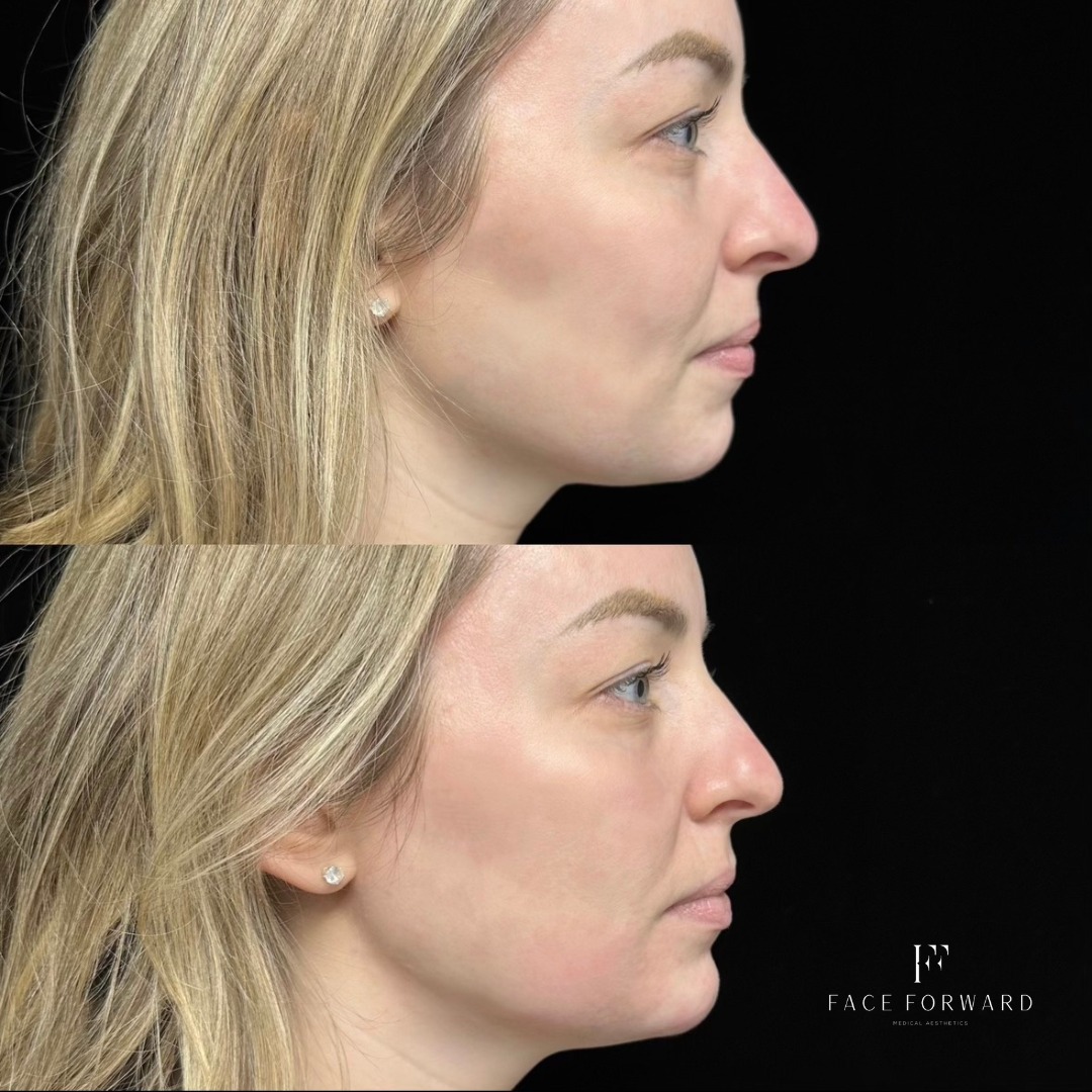 Dermal Filler Before & After Photos Face Forward Medical Aesthetics