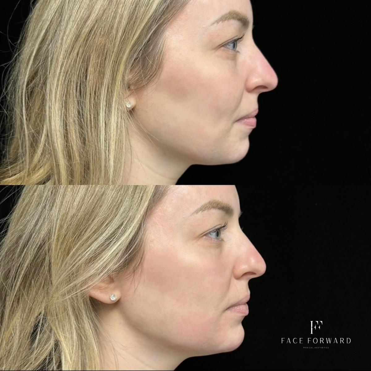 Dermal Filler Before & After Gallery - Patient 104346 - Image 2