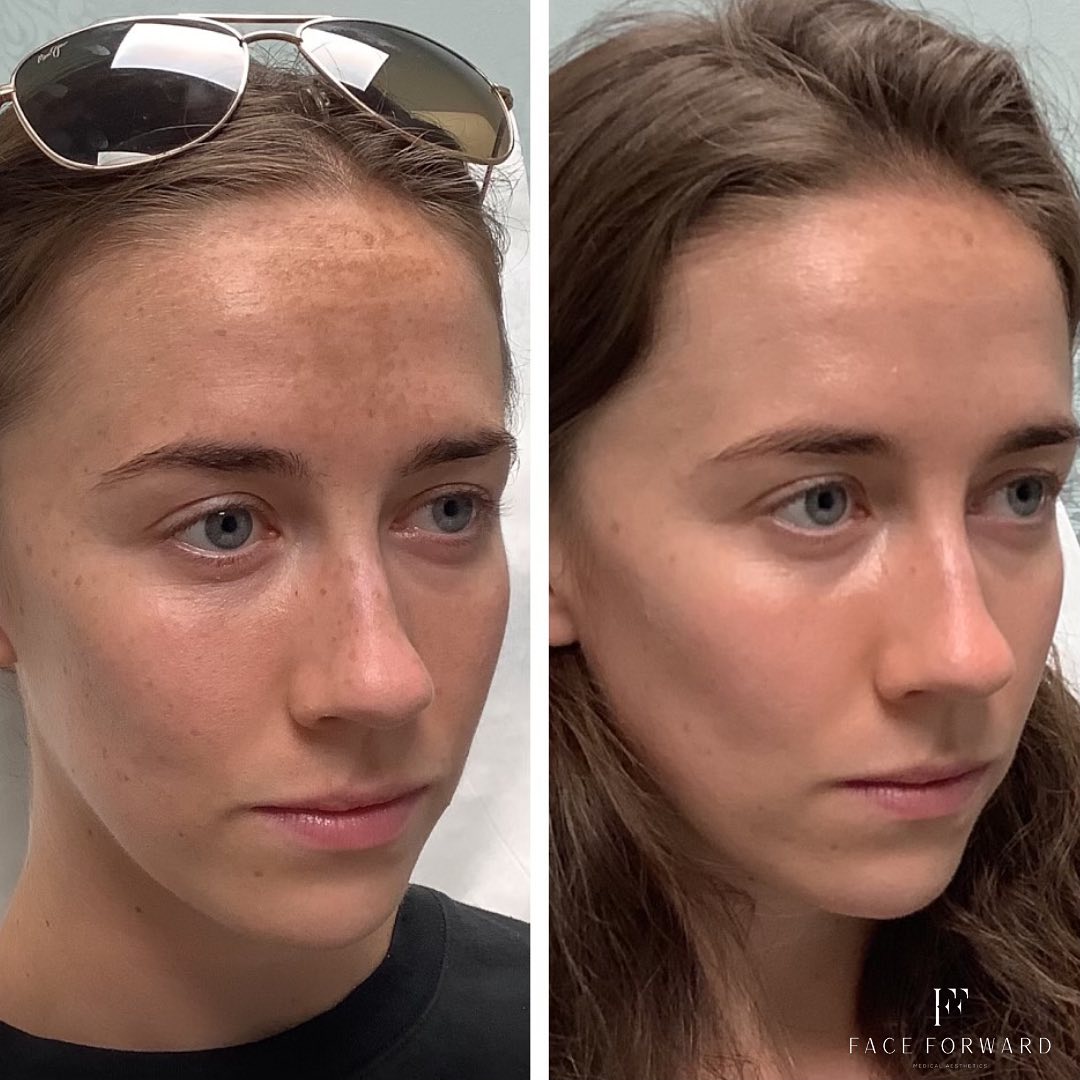 Skincare Before & After Photos Face Forward Medical Aesthetics