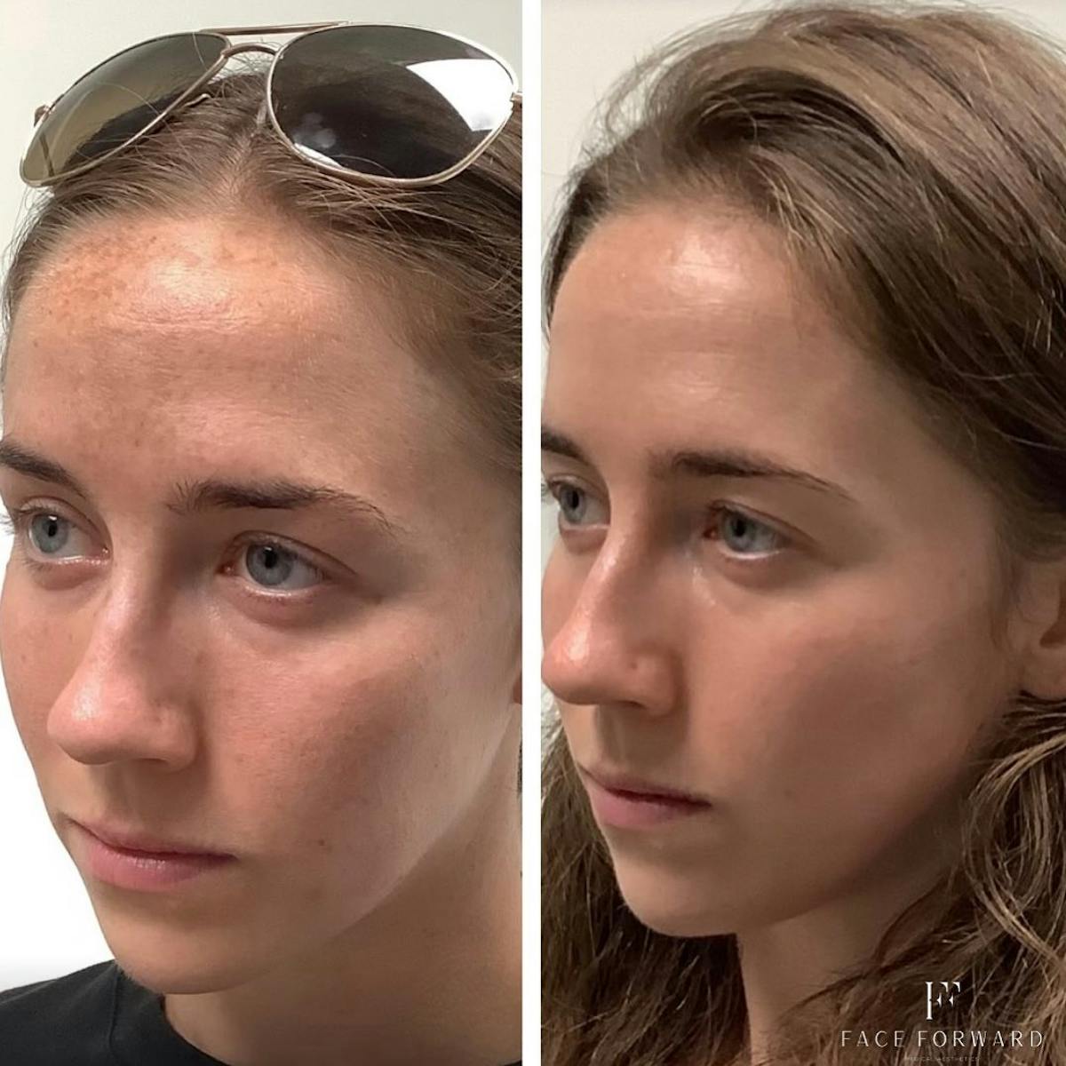 Skincare Before & After Gallery - Patient 405407 - Image 3