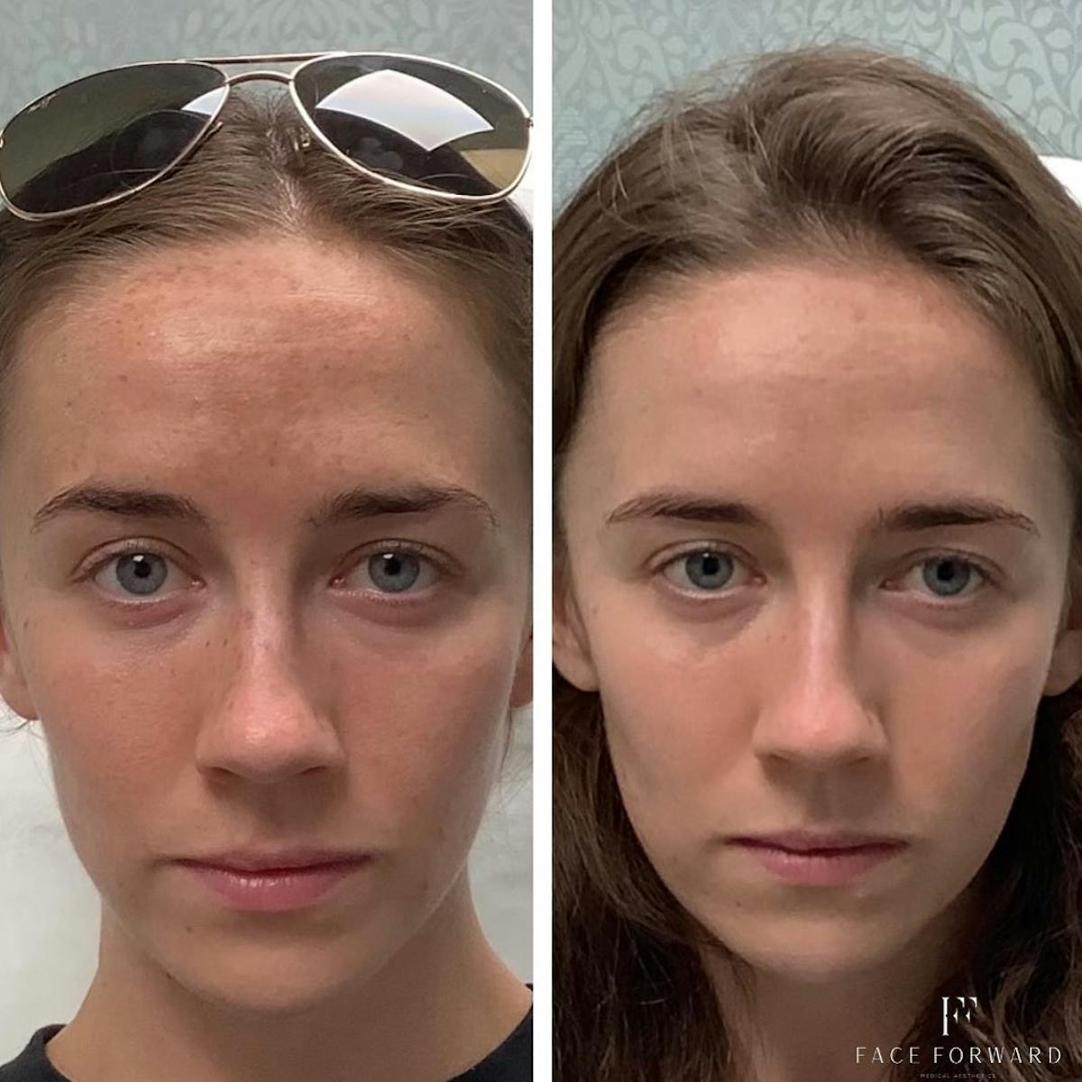 Skincare Before & After Gallery - Patient 405407 - Image 1