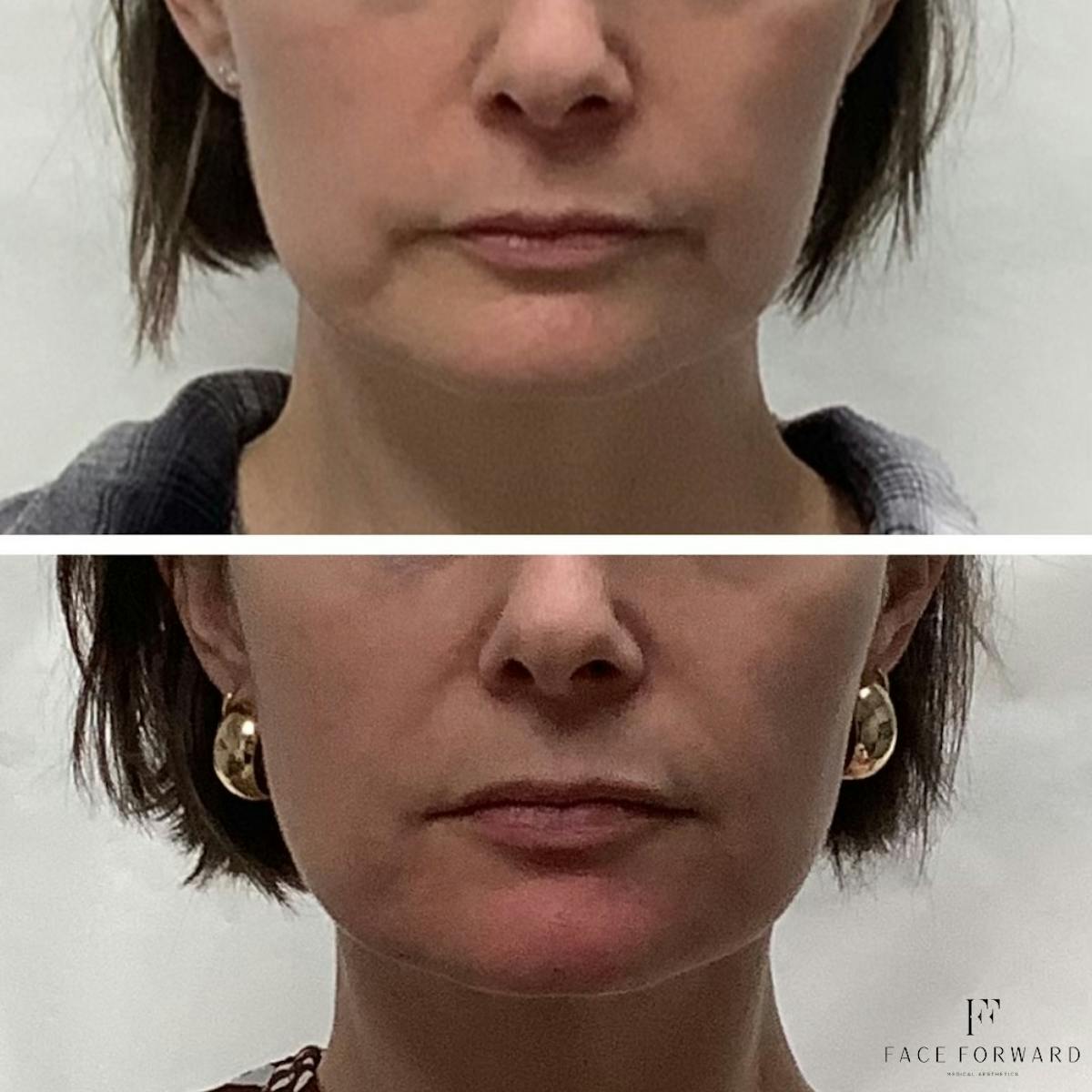 Botox & Dysport Before & After Gallery - Patient 564333 - Image 2