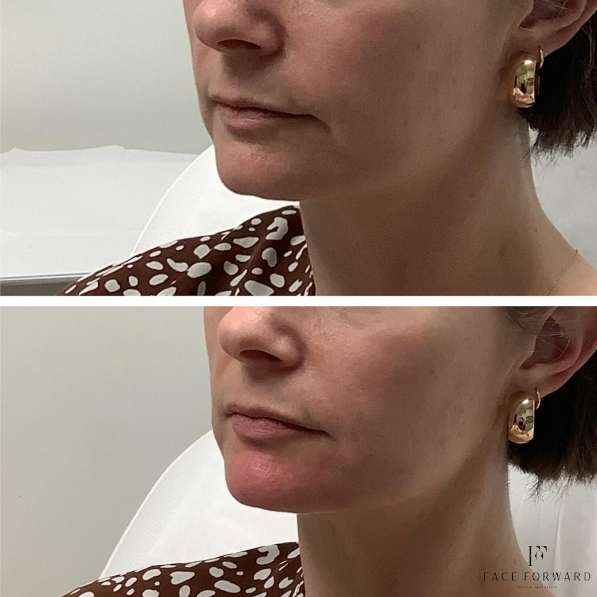 Botox & Dysport Before & After Gallery - Patient 564333 - Image 3