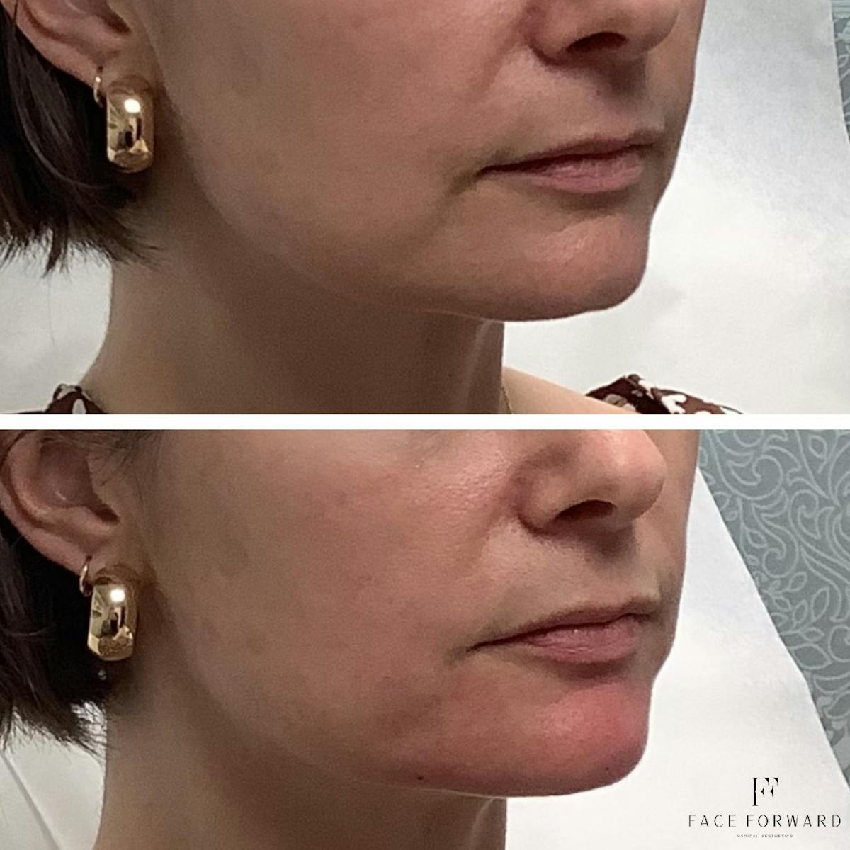 Botox & Dysport Before & After Gallery - Patient 564333 - Image 1
