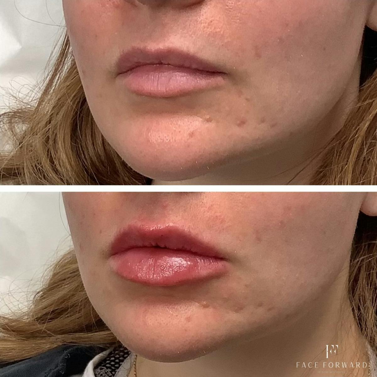 Dermal Filler Before & After Gallery - Patient 100114 - Image 2